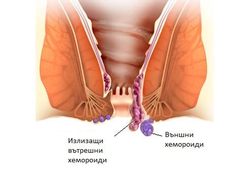 Външни хемороиди