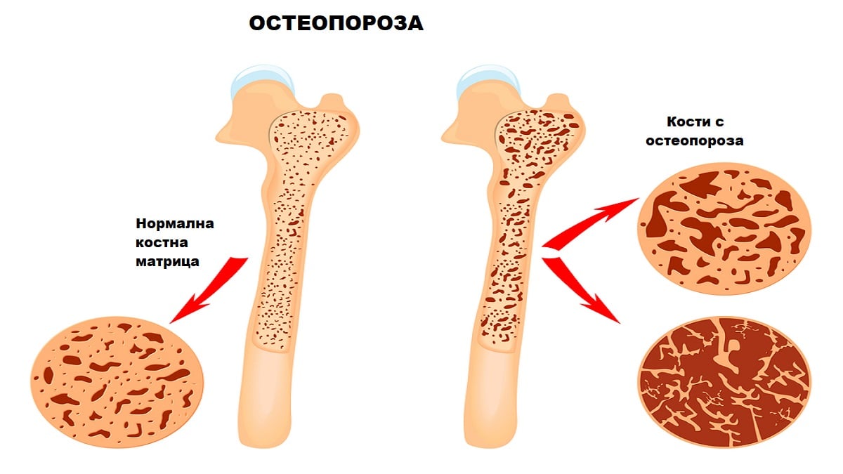 Как да лекуваме остеопороза с най-малко странични ефекти. Няма универсален